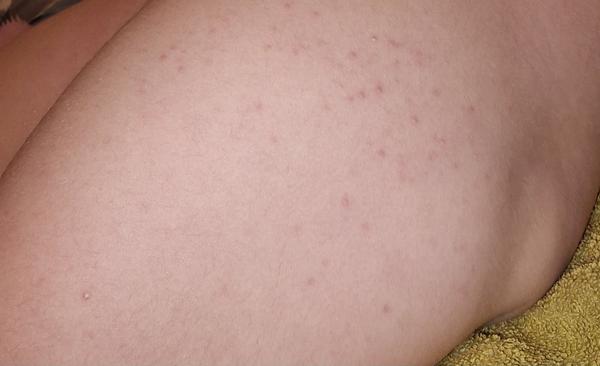 Kožné problémy u dcéry: Ako ich identifikovať?