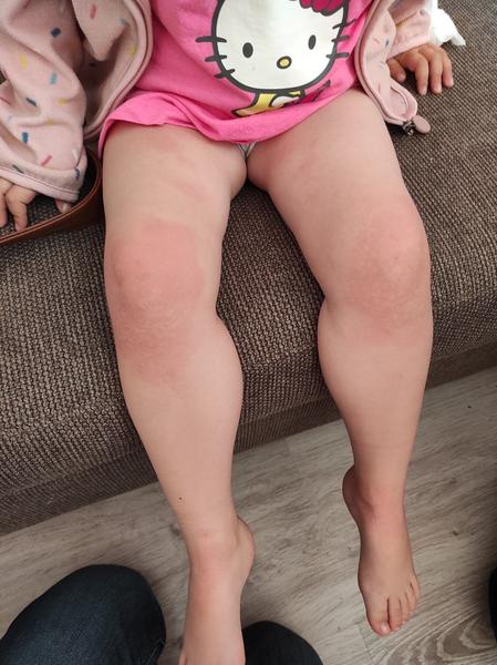 Z čoho môžu byť takéto pľuzgieriky?