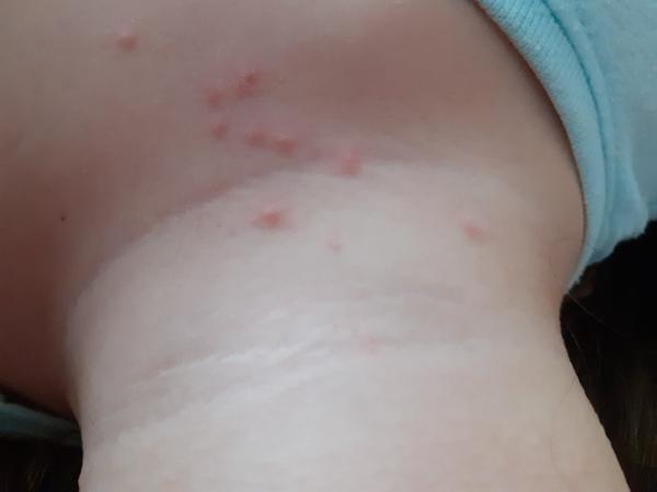 Čo pomôže proti štípancom?