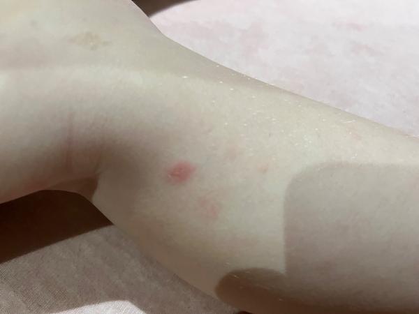 Čo spôsobuje vyrážky u štvorročného dieťaťa?