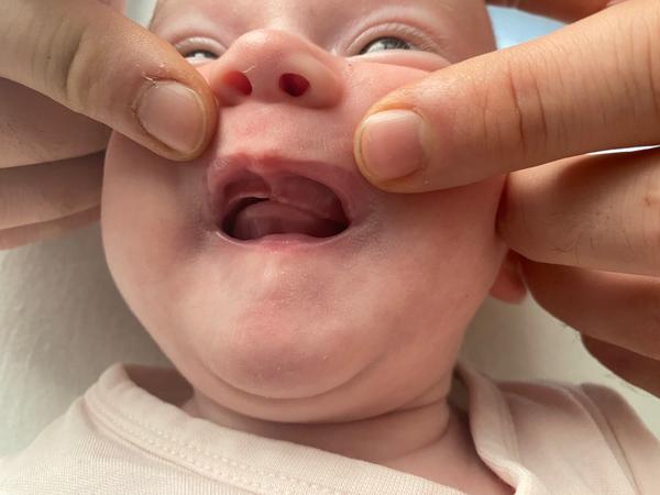 Dajú sa liečiť asymetrické horné ďasienka?