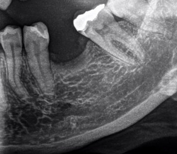 Dá sa výrazný úbytok kostnej drenie riešiť posunutím zubov strojčekom?