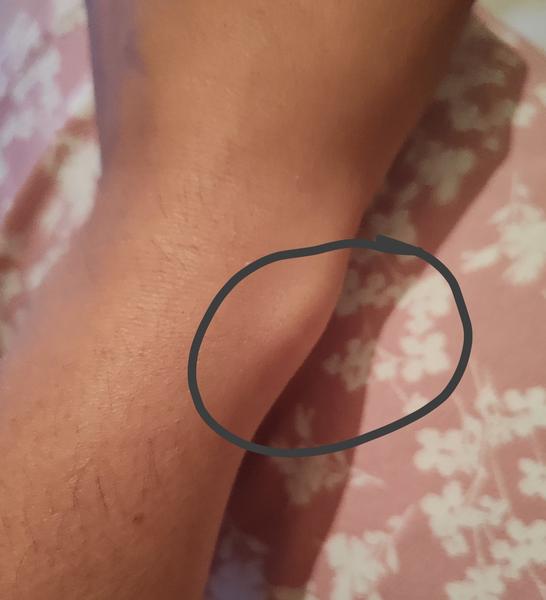 Ako riešiť tvrdú hrčku na zápästí?