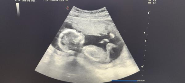 Ide o Downov syndróm?