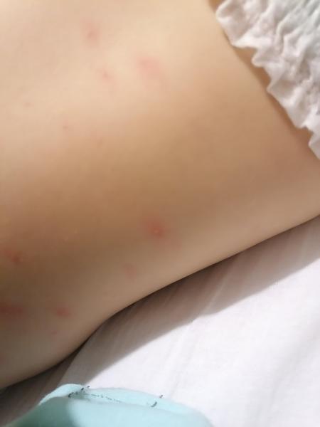 Vodnatá vyrážka u 1,5-ročného.