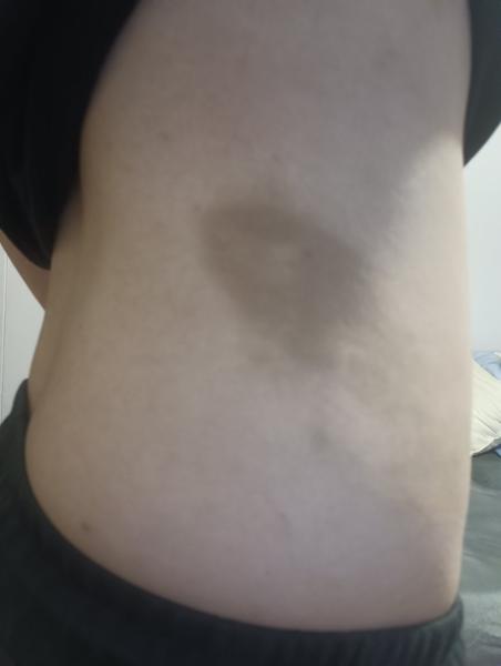 Čo spôsobuje kožné fľaky u detí?