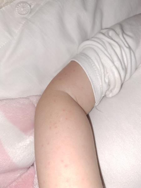 Z čoho sa mohli 2-ročnej dcérke vytvoriť takéto vyrážky?