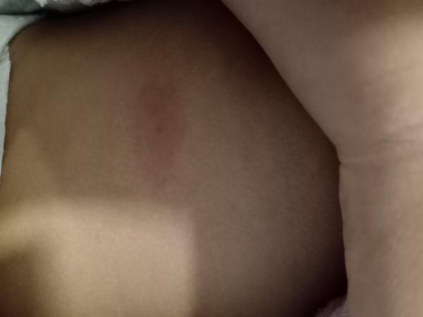 Čo to poštípalo moje dieťatko?