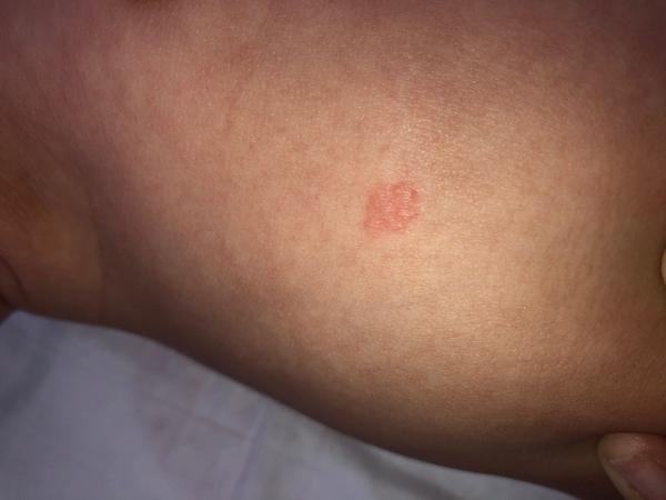 Aký výsyp to má môj trojmesačný synček?