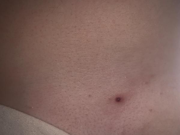 Čo znamenajú neobvyklé vyrážky na pokožke?