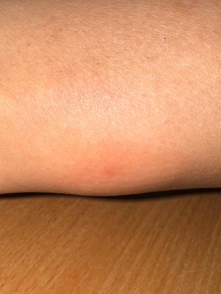 Kliešťová katastrofa: Je opuch dôvod na obavy?