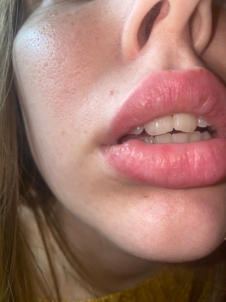 Hrčka na spodnej pere