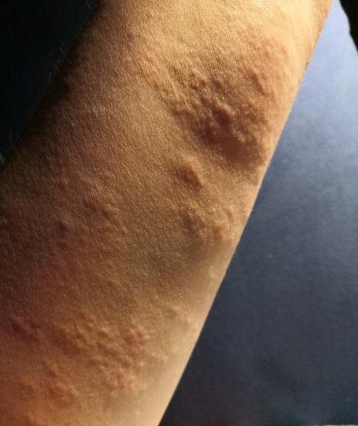 Čo sú toto za vyrážky?