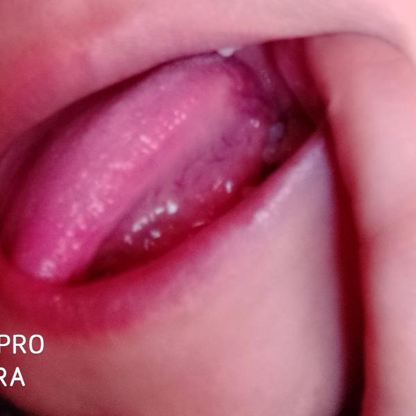 Sú papily na jazyku neškodné?