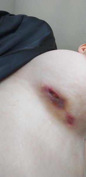 Vyriešte problém s hnisavou ranou po augmentácii prsníkov