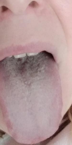 Môže ísť o candidu?