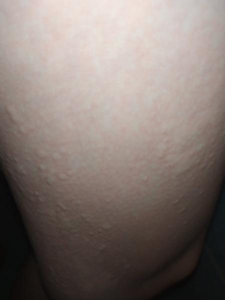 Týždeň sa mi robia takéto vyrážky, čo to môže byť ? 