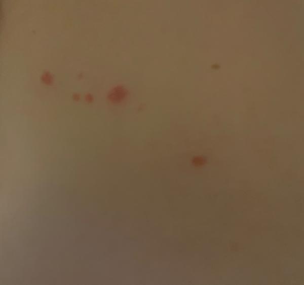 Moje vyrážky nesvrbia ani nebolia: Čo to môže byť?