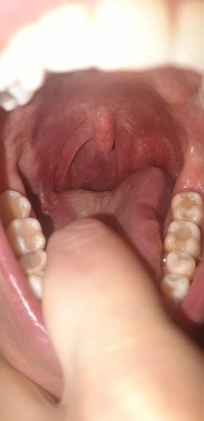 Ako postupovať pri liečbe jamky v ústach?