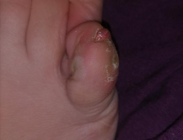 Otrasná bolesť malíčka: Ako ju riešiť?