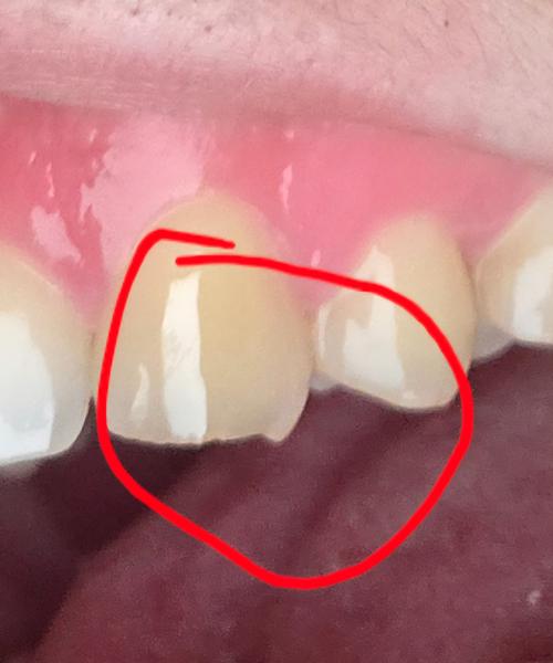 Bolestivý zub pri zahryznutí