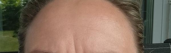 Ako najlepšie odstrániť vrásky na čele a vrásky hnevu?