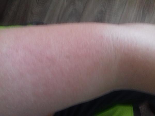 Je to alergia na slnko?