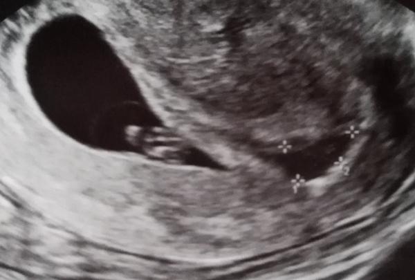 Syndróm miznucého dvojčaťa