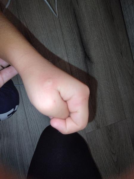 Bude mať môj syn kiahne?