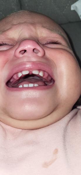 Môže ísť 8-mesačnej dcére očný zub?