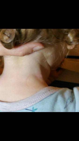 Mohol sa dvojročný syn nakaziť boreliózou?