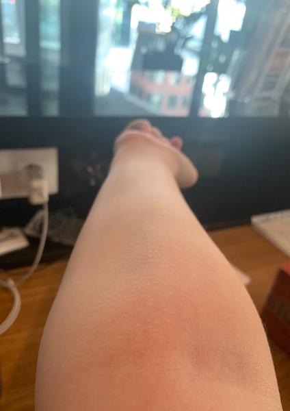 Čo sú toto za vyrážky ?