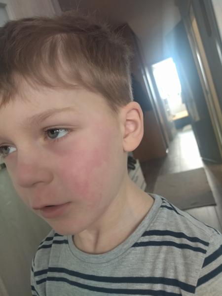 Červené fľaky na tvári. Piata choroba alebo niečo iné?