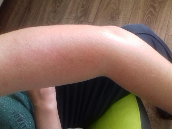 Je to alergia na slnko?