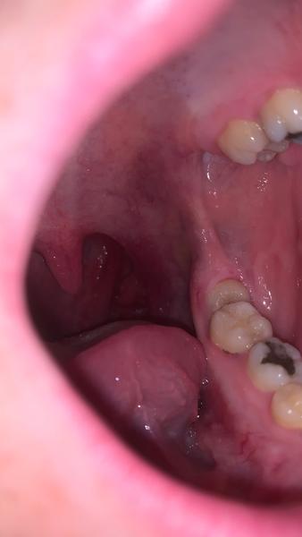 Je to kvapavka v hrdle?