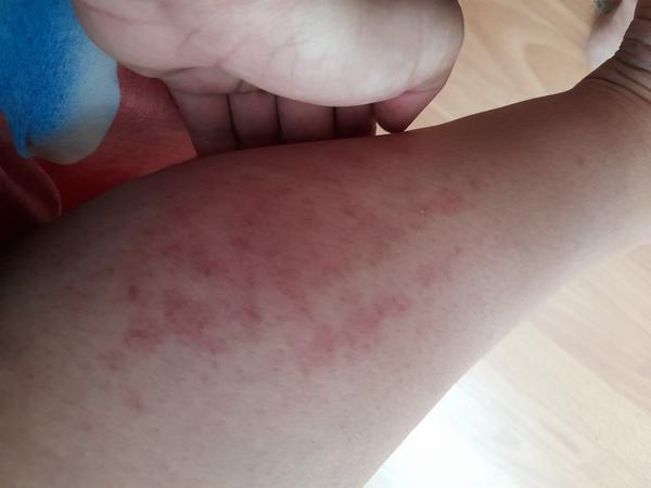 Doštípali ma ploštice?