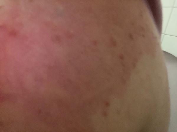 Môže byť škrabanie tela cholestáza?