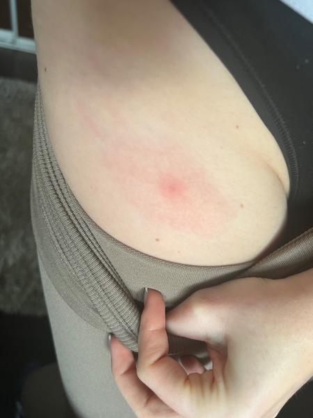 Z čoho sa mi na nohe vytvoril takýto červený fľak?