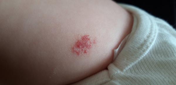 Červená škvrna u bábätka.