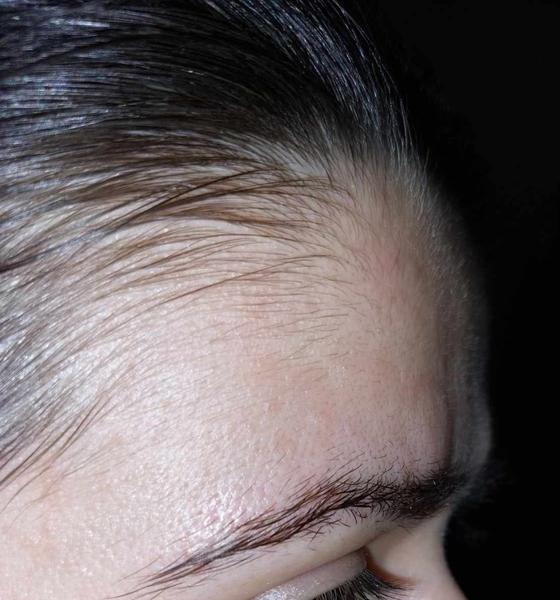 Ako sa zbaviť pálivých vyrážok na čele?