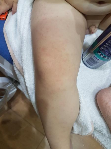 Sú tieto vyrážky u 2,5 ročného syna alergického pôvodu?