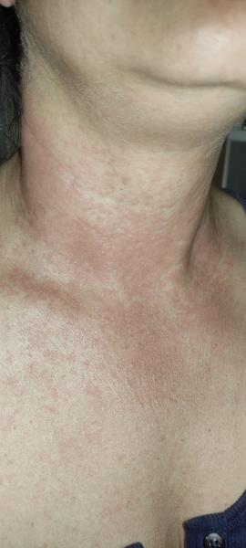 Je to pásový opar? Zistite čo robiť!