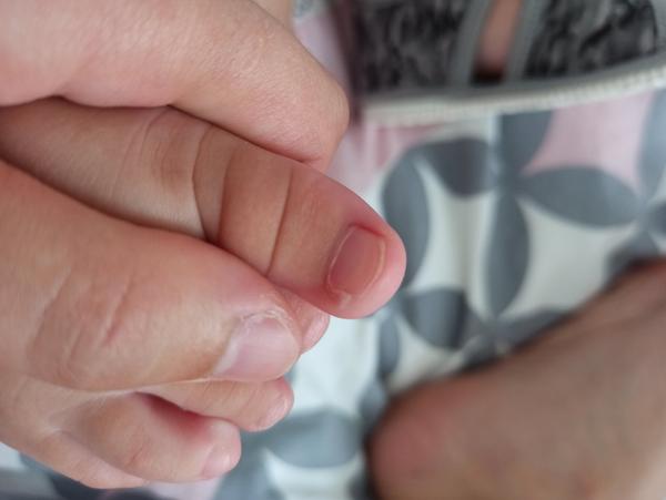 Buchnutý a nalomený necht