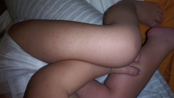 Malo vaše dieťa niečo podobné na tele?