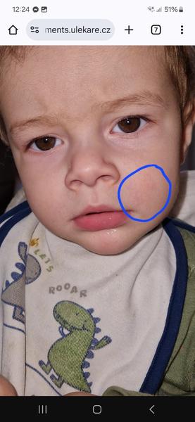 Nejasný červený fliačik na tvári dieťaťa: Máte skúsenosti?