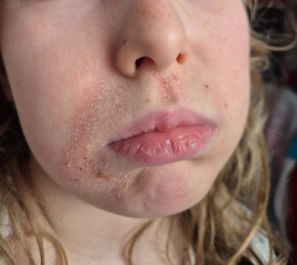 Čo môže spôsobovať ekzém?