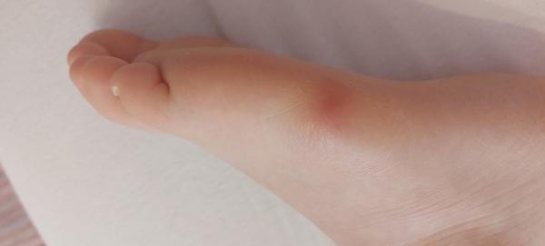 Dcérke sa spravila na nohe vyrážka