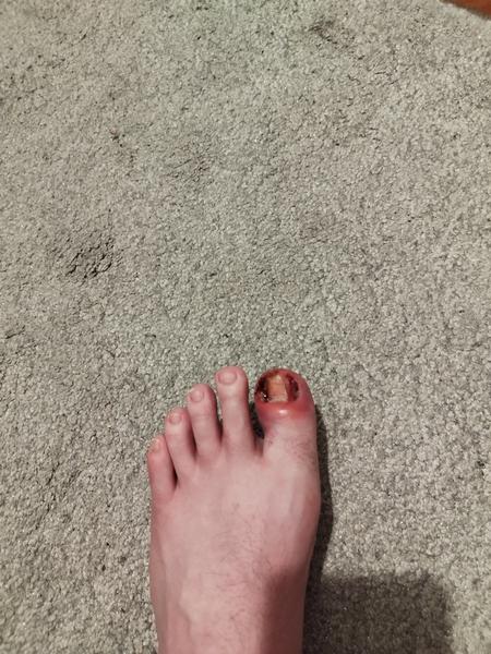 Je zarastený necht príčinou opuchu?