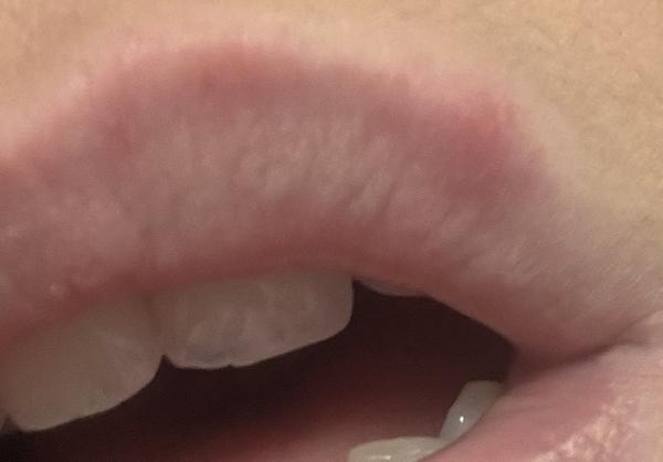 Asi mám herpes. Čo ak sa bábätko nakazilo?