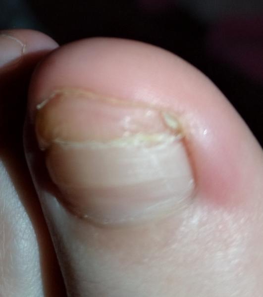 Udrela som si prst a odpadol mi necht